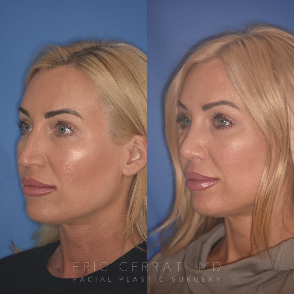 40 YR - 2 Months Postop: Rhinoplasty