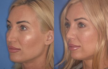 40 YR - 2 Months Postop: Rhinoplasty