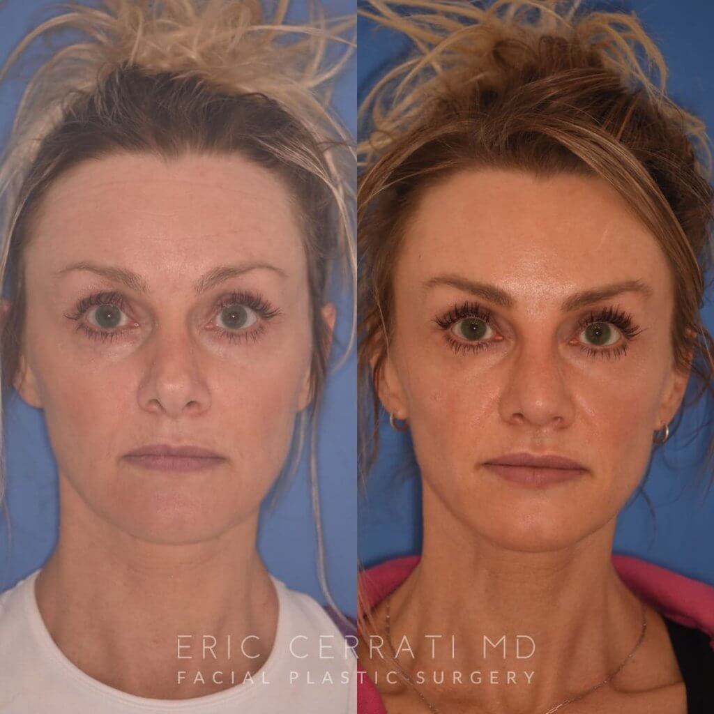 photo of 42 YR patient before and 4 months post op Revision Rhinoplasty