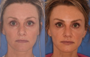 photo of 42 YR patient before and 4 months post op Revision Rhinoplasty