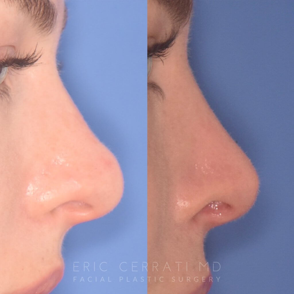before and after rhinoplasty procedure