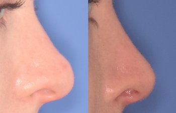 before and after rhinoplasty procedure