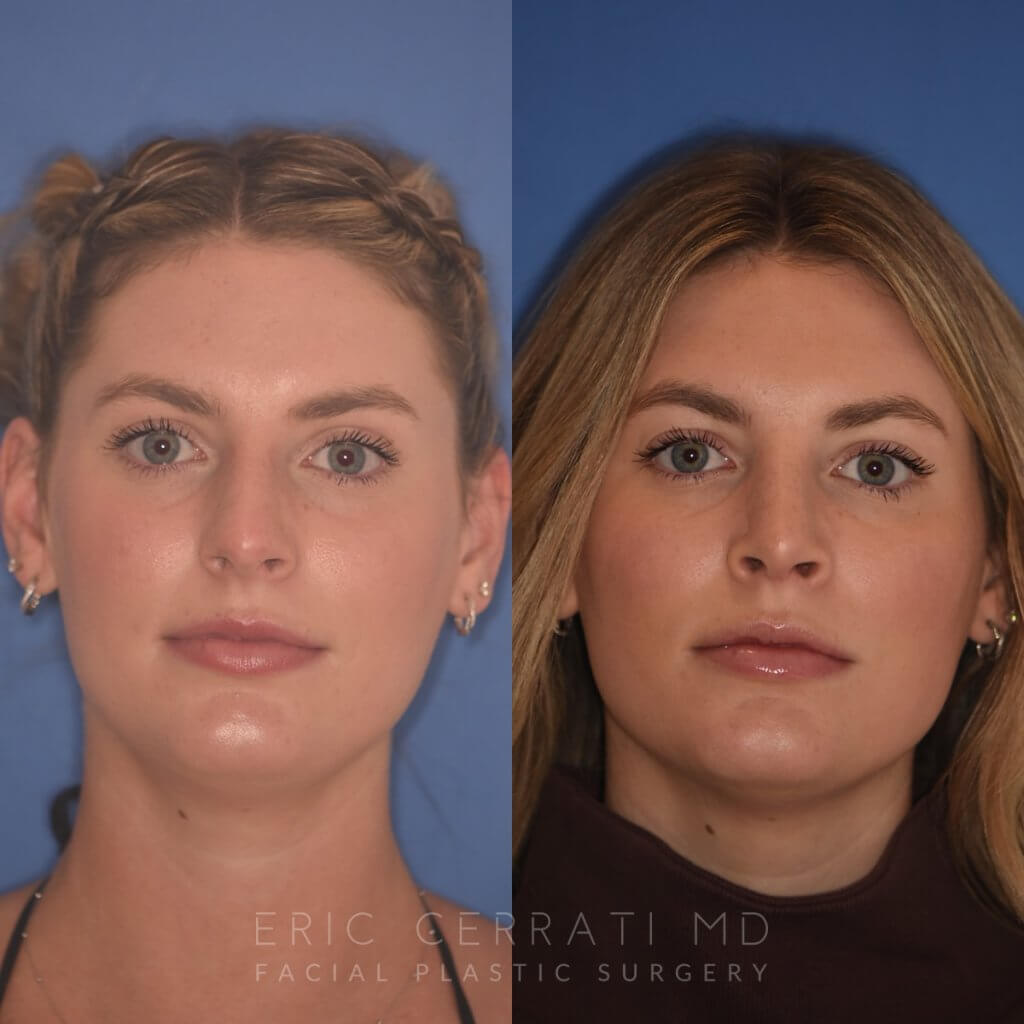 patient before and after rhinoplasty
