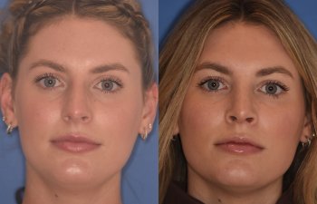 patient before and after rhinoplasty