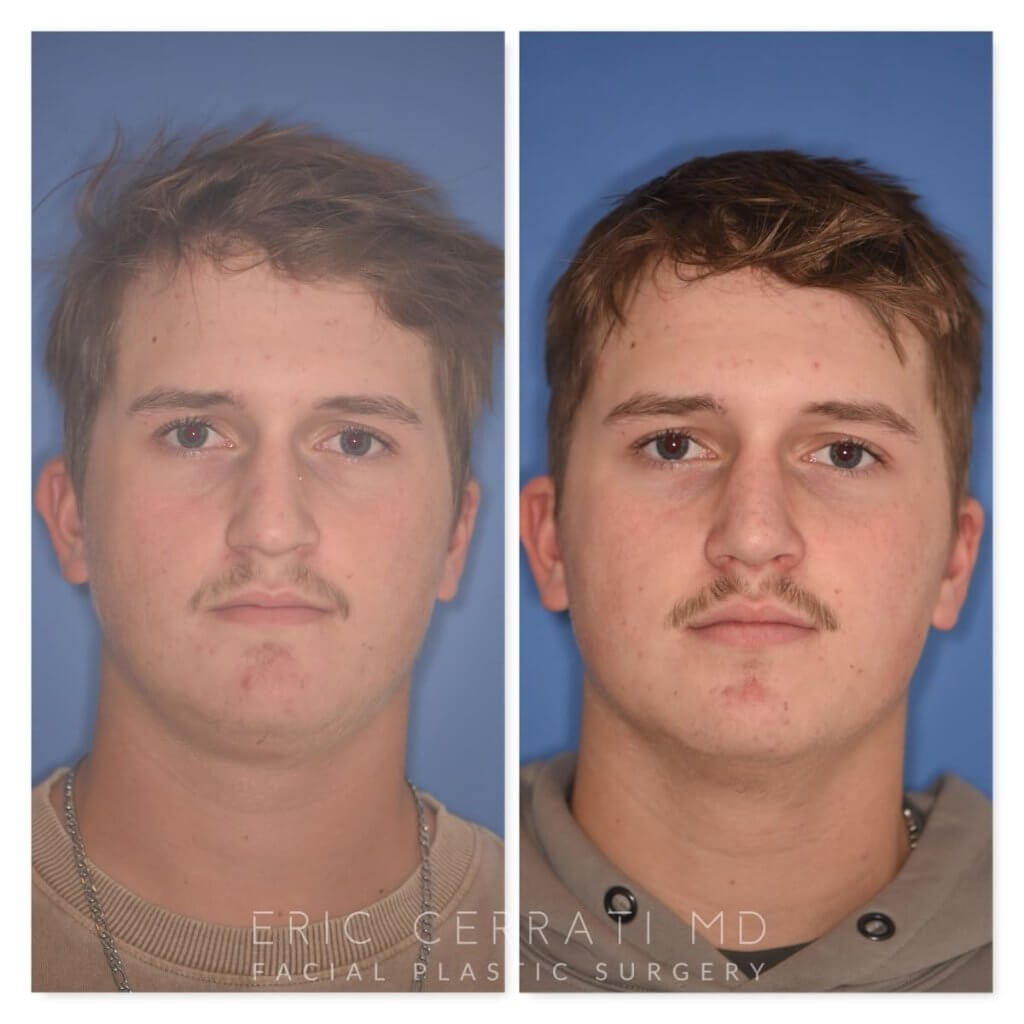 photo of 16 YR patient before and 2 months post op Rhinoplasty