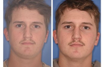 photo of 16 YR patient before and 2 months post op Rhinoplasty