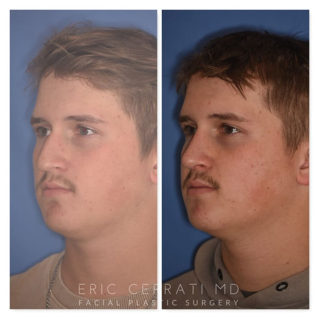 photo of 16 YR patient before and 2 months post op Rhinoplasty