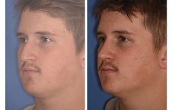 photo of 16 YR patient before and 2 months post op Rhinoplasty