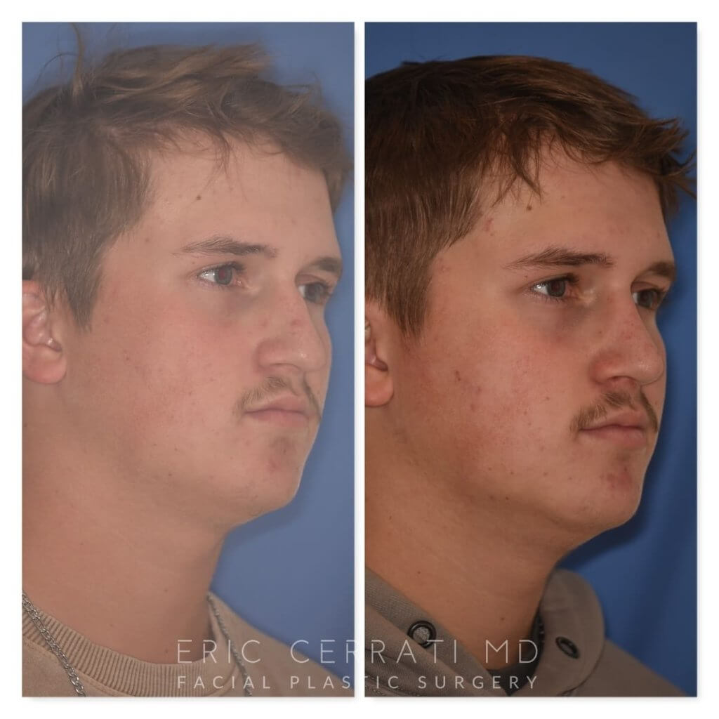 photo of 16 YR patient before and 2 months post op Rhinoplasty