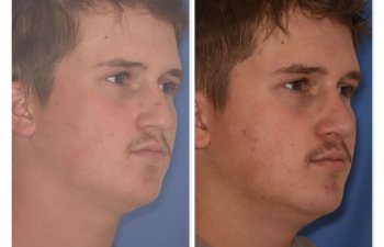 photo of 16 YR patient before and 2 months post op Rhinoplasty