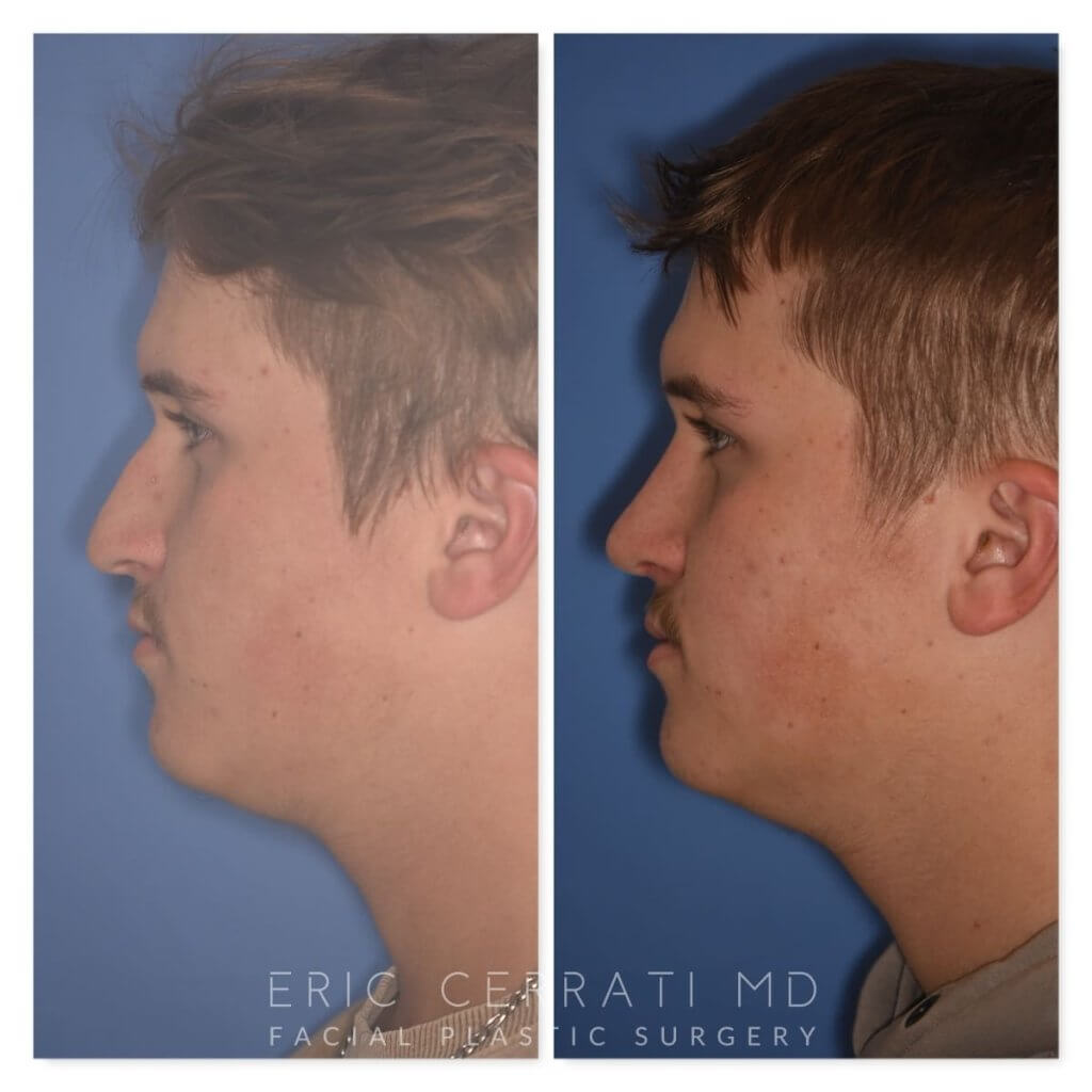 photo of 16 YR patient before and 2 months post op Rhinoplasty