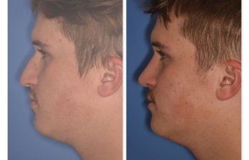photo of 16 YR patient before and 2 months post op Rhinoplasty