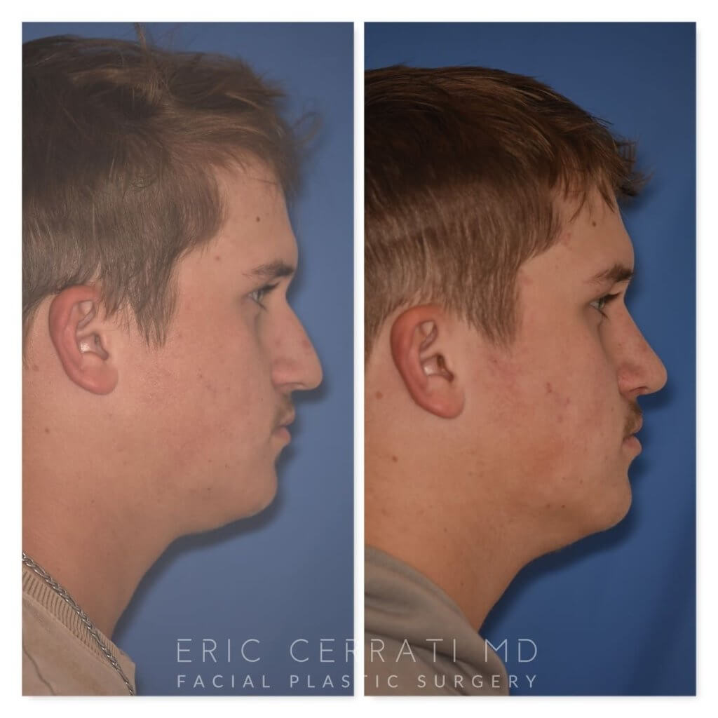 photo of 16 YR patient before and 2 months post op Rhinoplasty