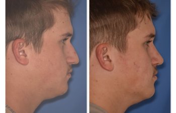 photo of 16 YR patient before and 2 months post op Rhinoplasty