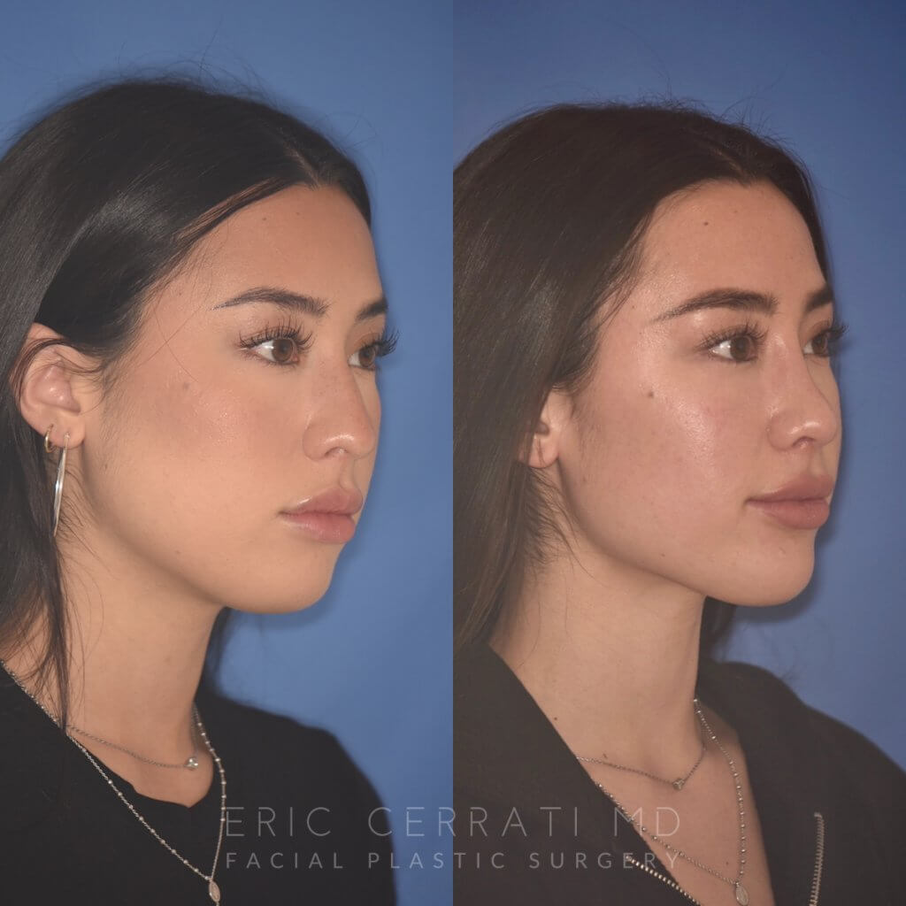 24 YR - 2 Months Postop: Rhinoplasty