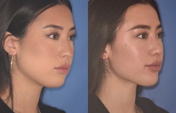 24 YR - 2 Months Postop: Rhinoplasty