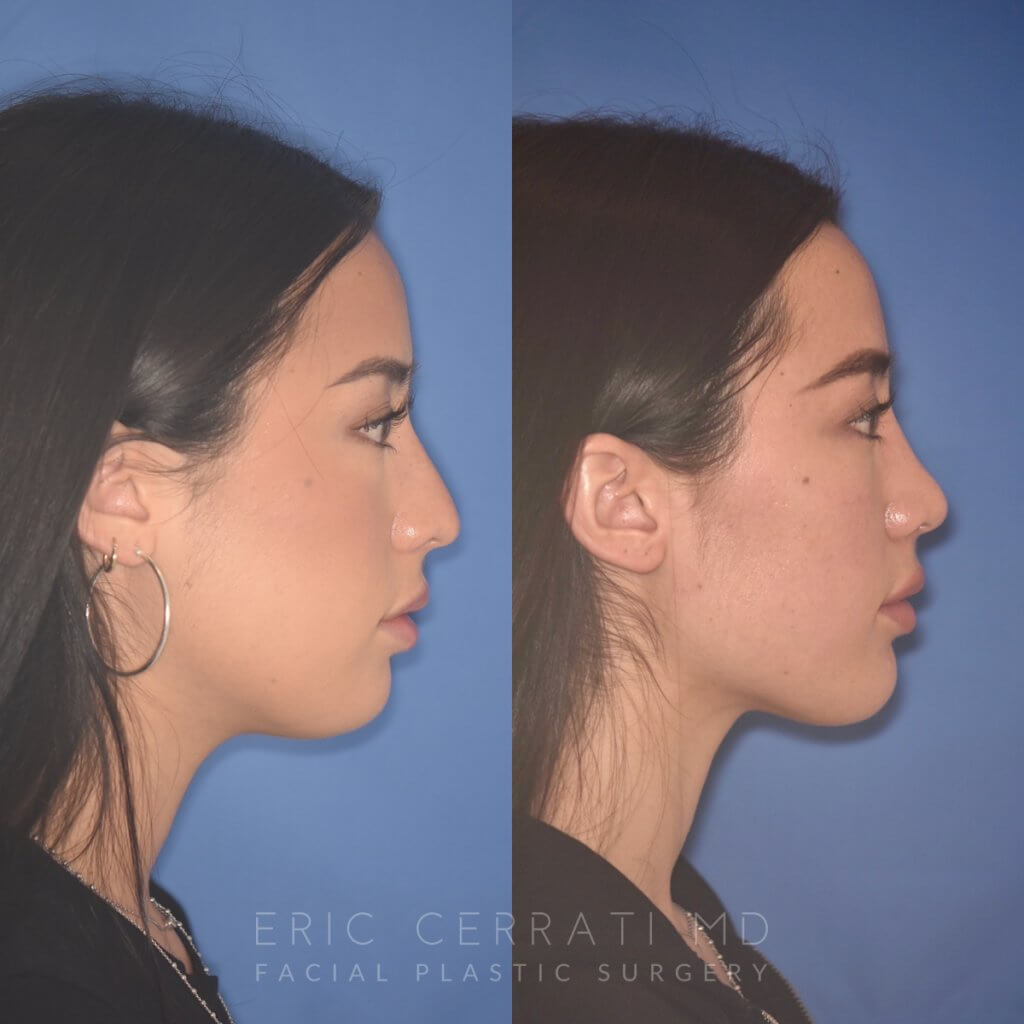 24 YR - 2 Months Postop: Rhinoplasty