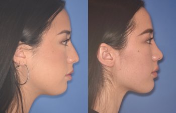 24 YR - 2 Months Postop: Rhinoplasty