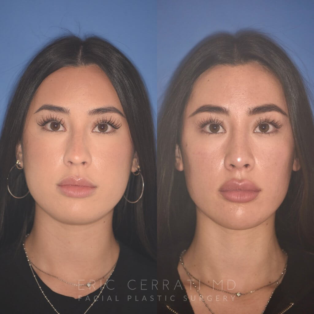 24 YR - 2 Months Postop: Rhinoplasty