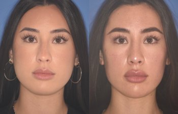 24 YR - 2 Months Postop: Rhinoplasty