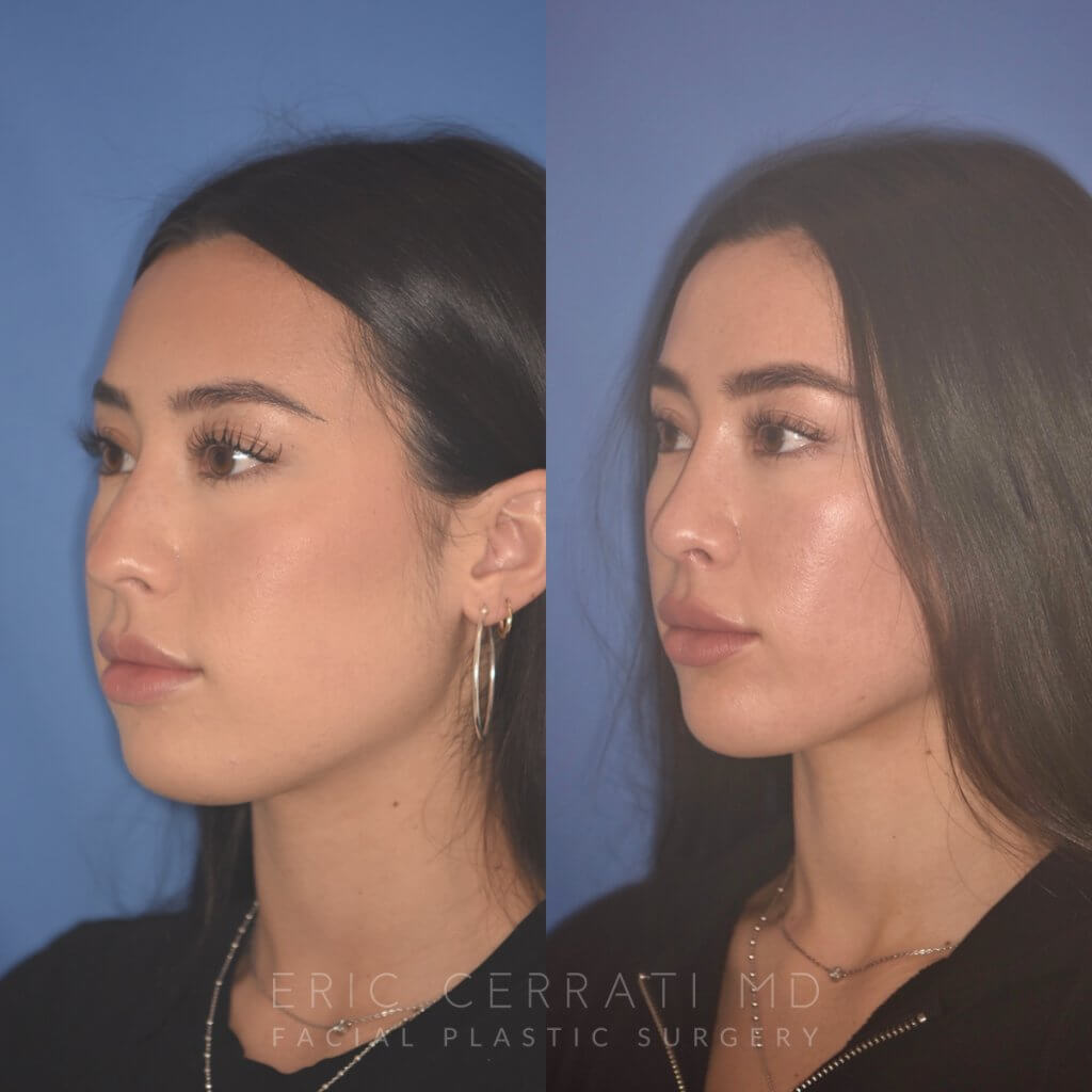 24 YR - 2 Months Postop: Rhinoplasty
