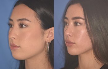 24 YR - 2 Months Postop: Rhinoplasty