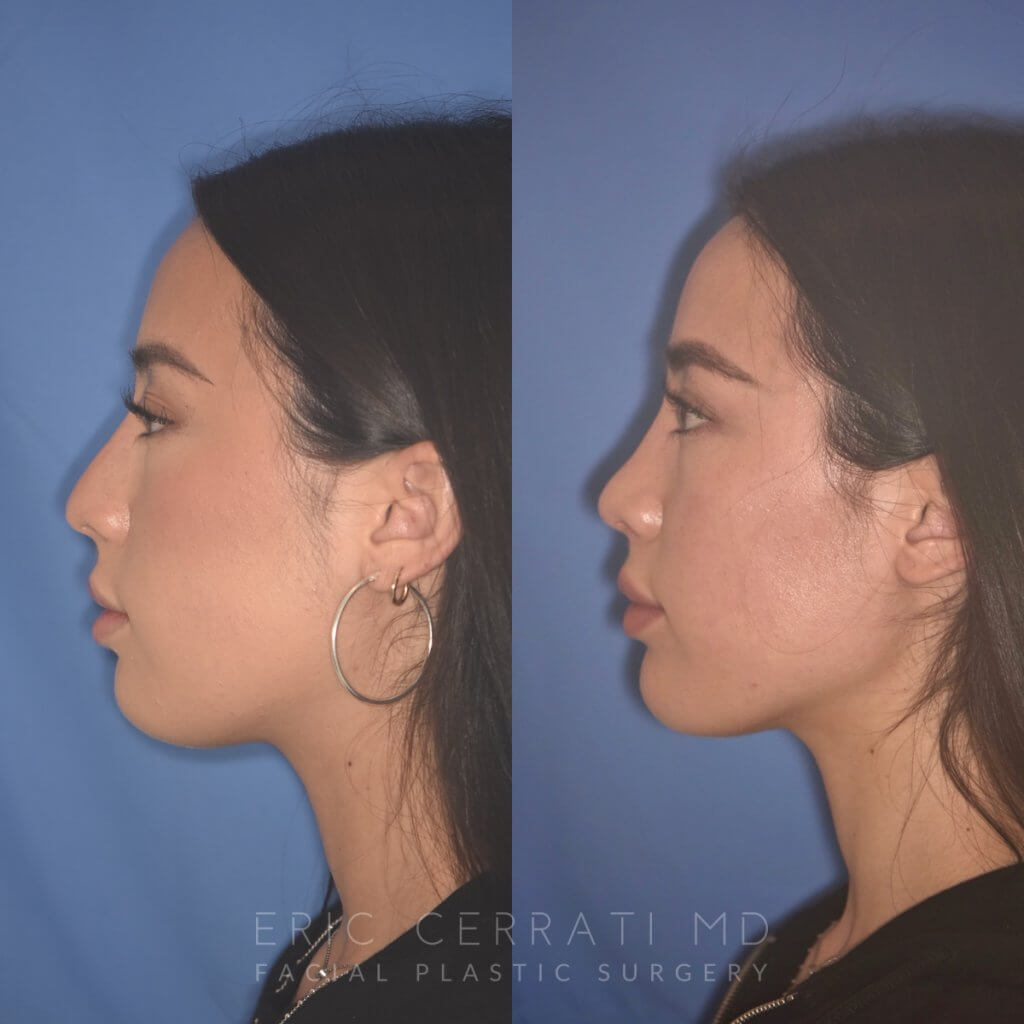 24 YR - 2 Months Postop: Rhinoplasty