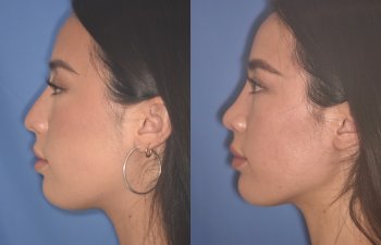 24 YR - 2 Months Postop: Rhinoplasty