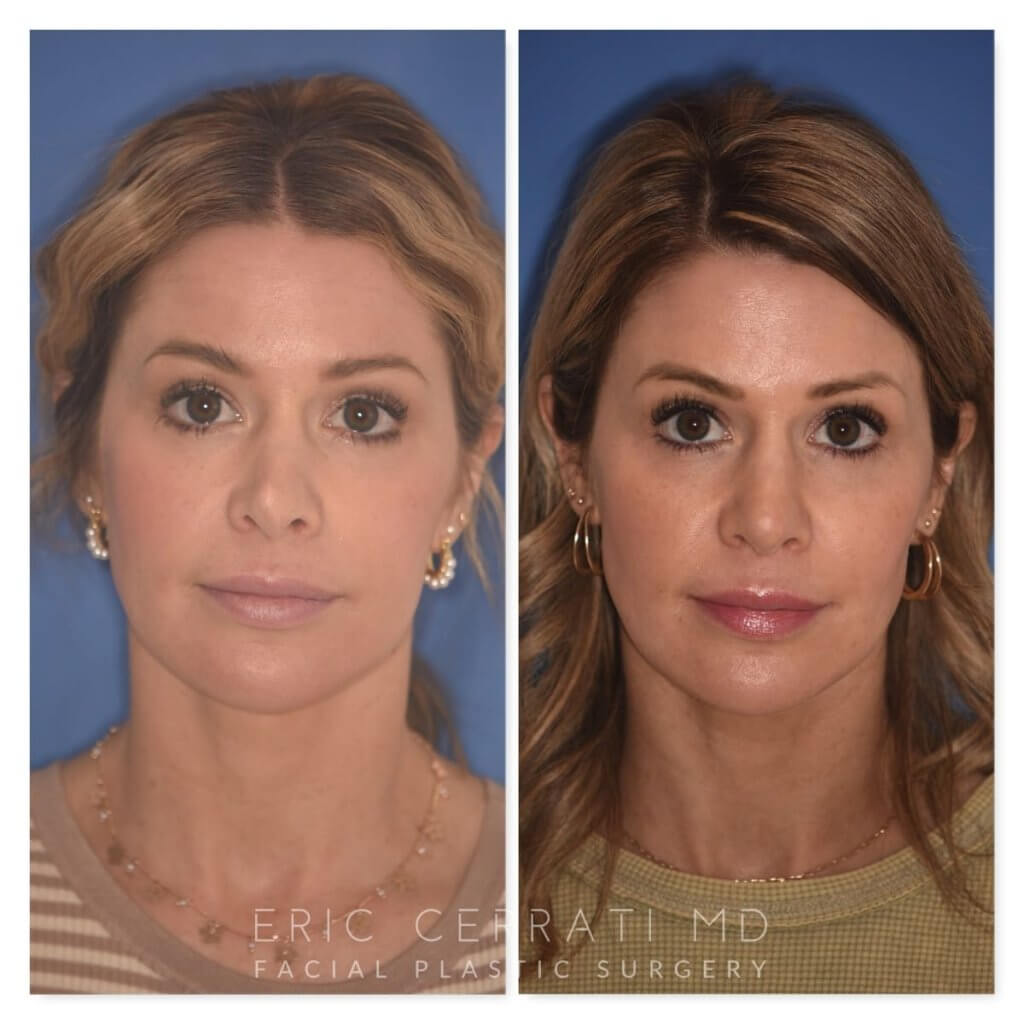 photo of 41 YR patient before and 4.5 months post op Rhinoplasty, front view