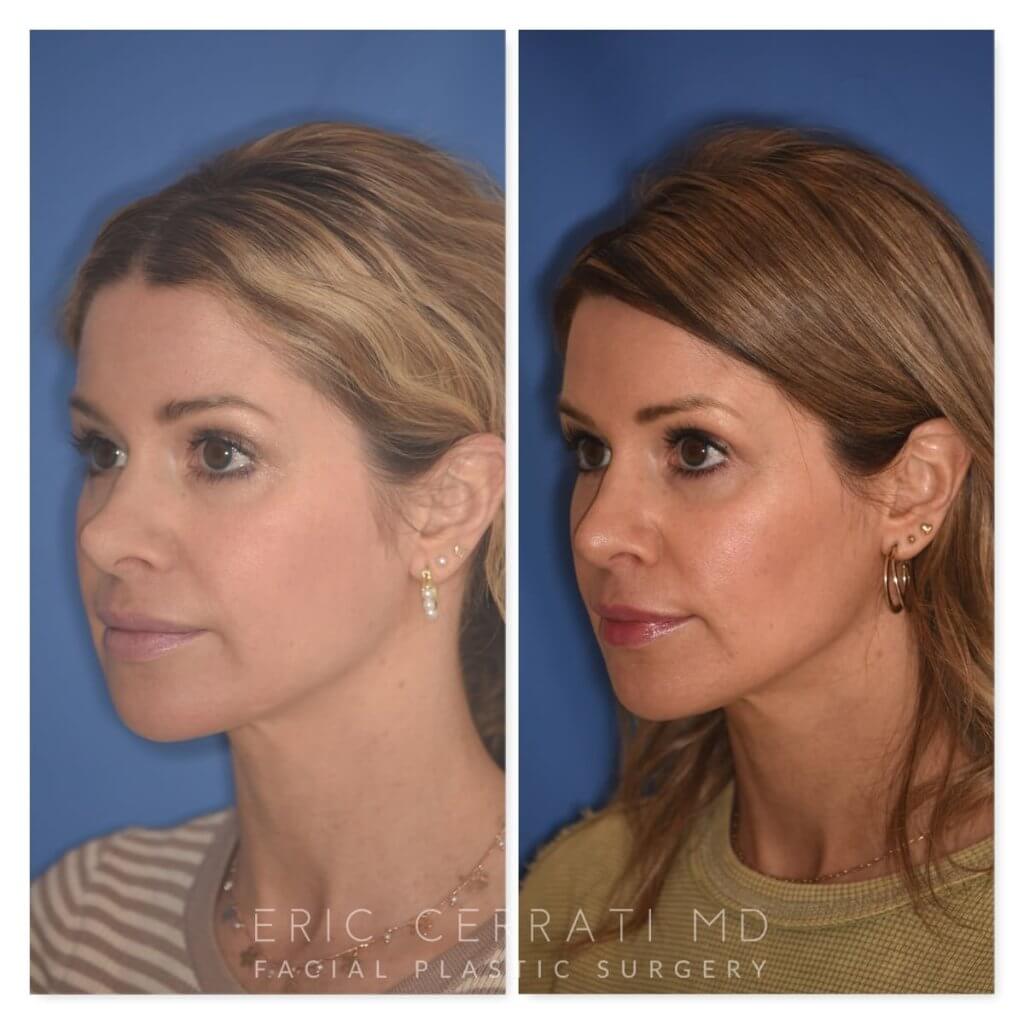photo of 41 YR patient before and 4.5 months post op Rhinoplasty, left oblique view