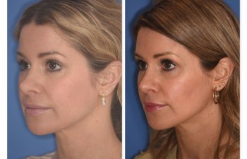 photo of 41 YR patient before and 4.5 months post op Rhinoplasty, left oblique view