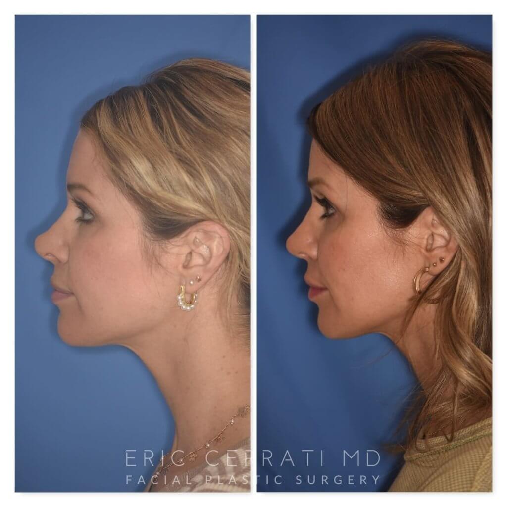 photo of 41 YR patient before and 4.5 months post op Rhinoplasty, left side view