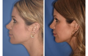 photo of 41 YR patient before and 4.5 months post op Rhinoplasty, left side view