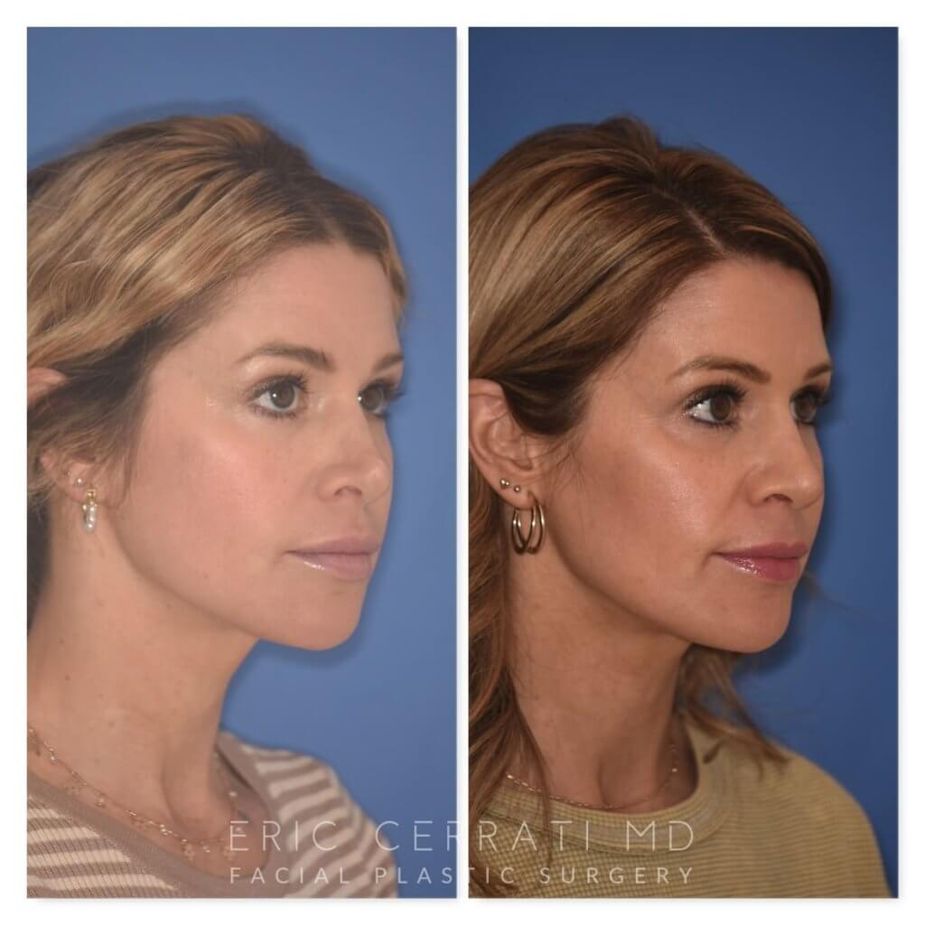 photo of 41 YR patient before and 4.5 months post op Rhinoplasty, right oblique view