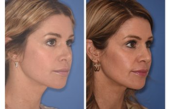 photo of 41 YR patient before and 4.5 months post op Rhinoplasty, right oblique view