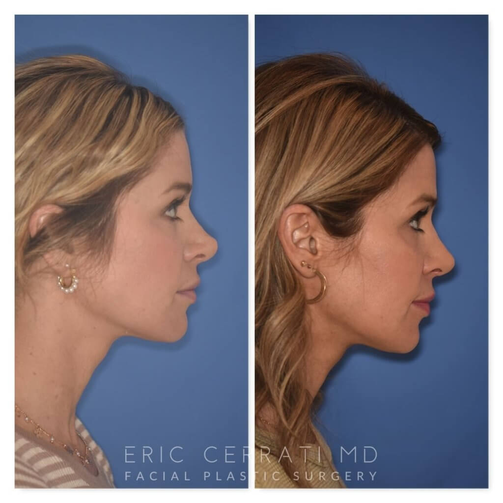 photo of 41 YR patient before and 4.5 months post op Rhinoplasty, right side view