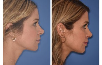 photo of 41 YR patient before and 4.5 months post op Rhinoplasty, right side view