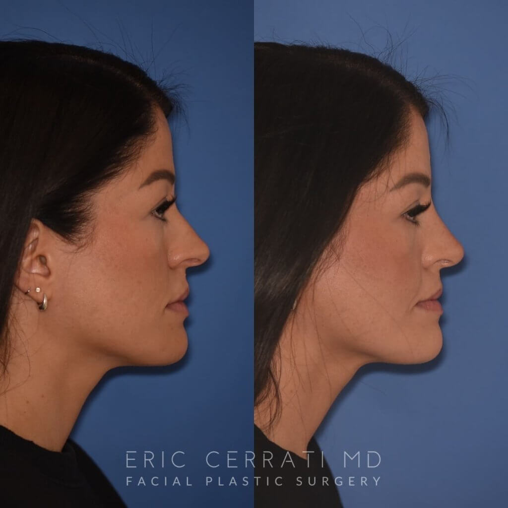 right side - 34 YR - 2 Months Postop: Rhinoplasty