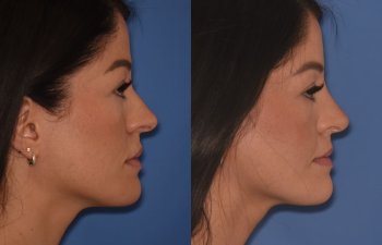 right side - 34 YR - 2 Months Postop: Rhinoplasty