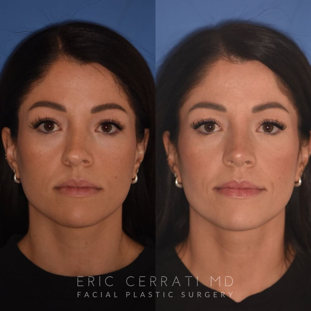 front - 34 YR - 2 Months Postop: Rhinoplasty