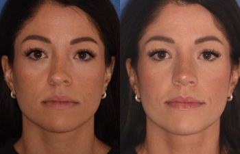 front - 34 YR - 2 Months Postop: Rhinoplasty