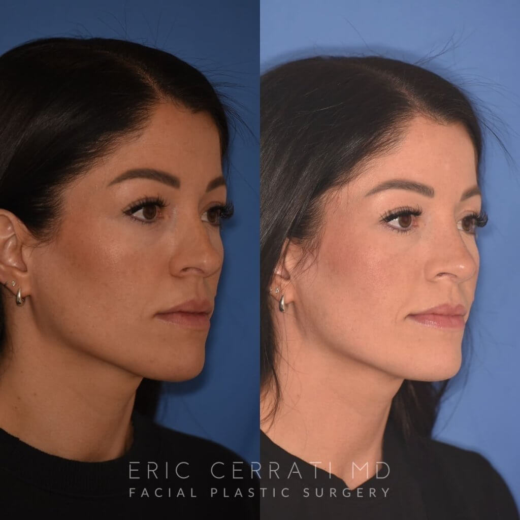 right oblique - 34 YR - 2 Months Postop: Rhinoplasty