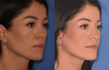 right oblique - 34 YR - 2 Months Postop: Rhinoplasty
