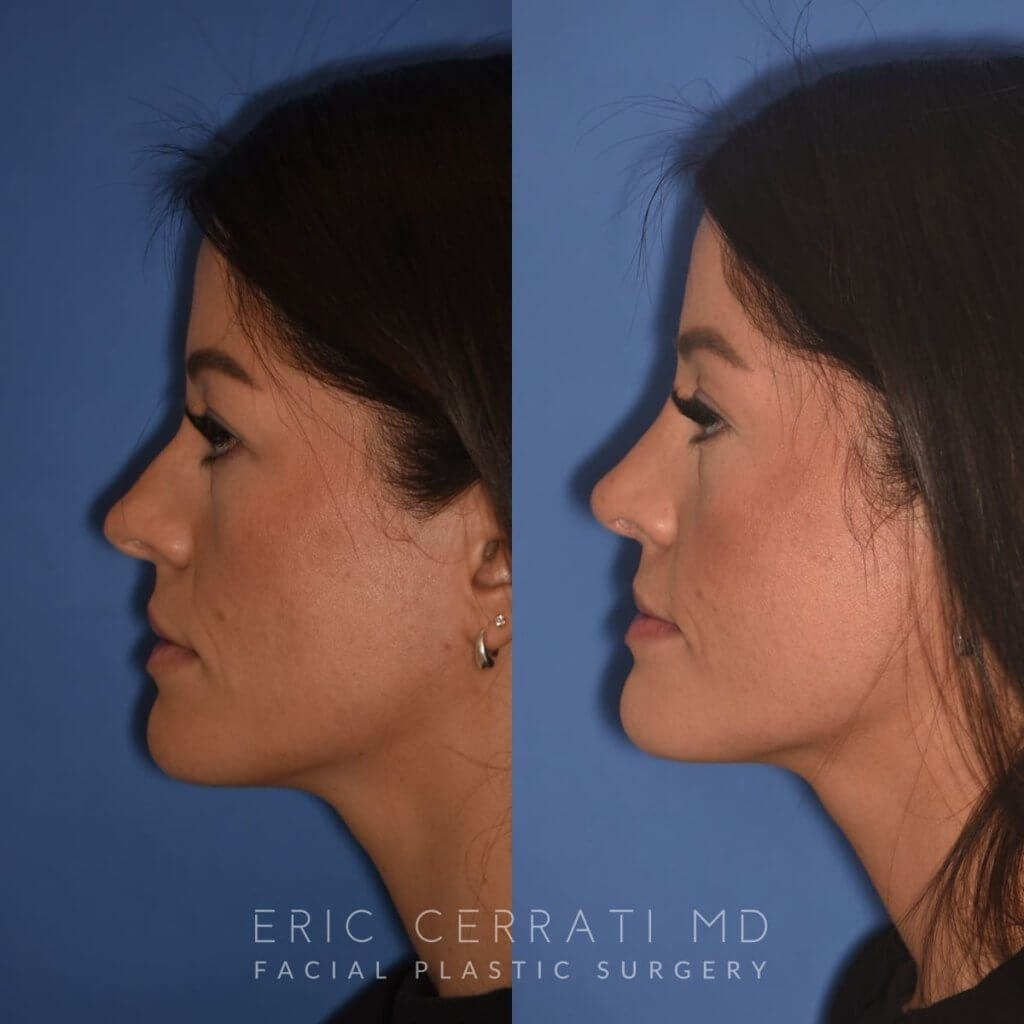 left side - 34 YR - 2 Months Postop: Rhinoplasty