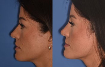left side - 34 YR - 2 Months Postop: Rhinoplasty