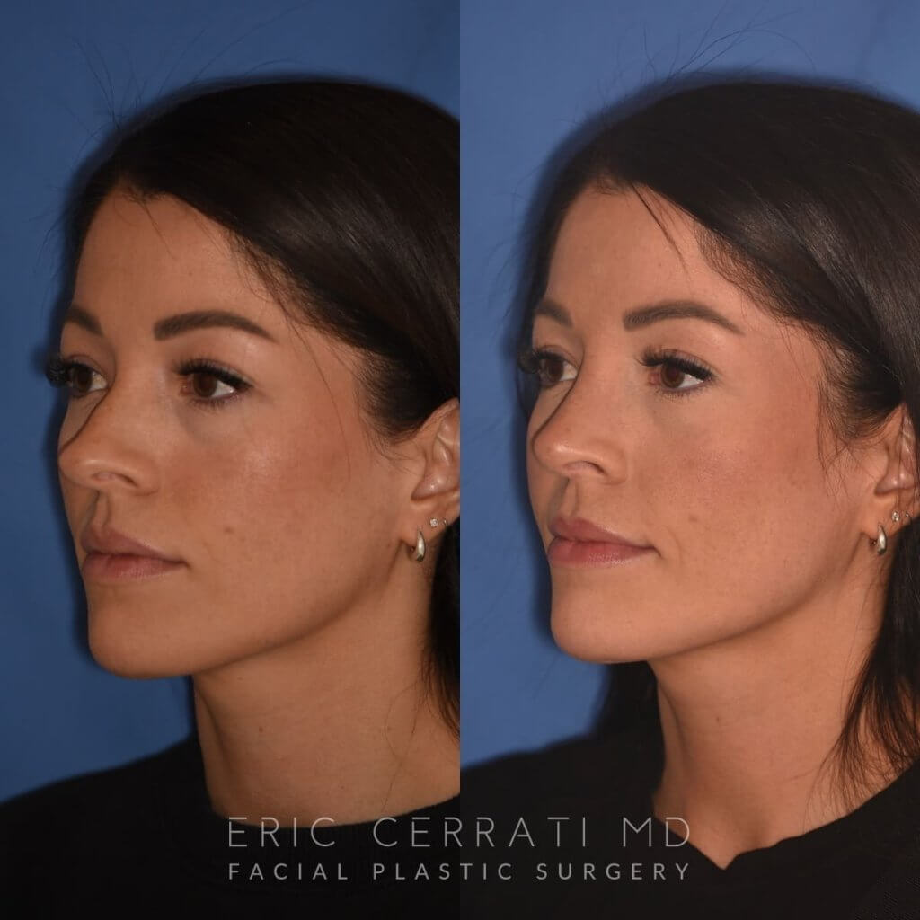 left oblique - 34 YR - 2 Months Postop: Rhinoplasty