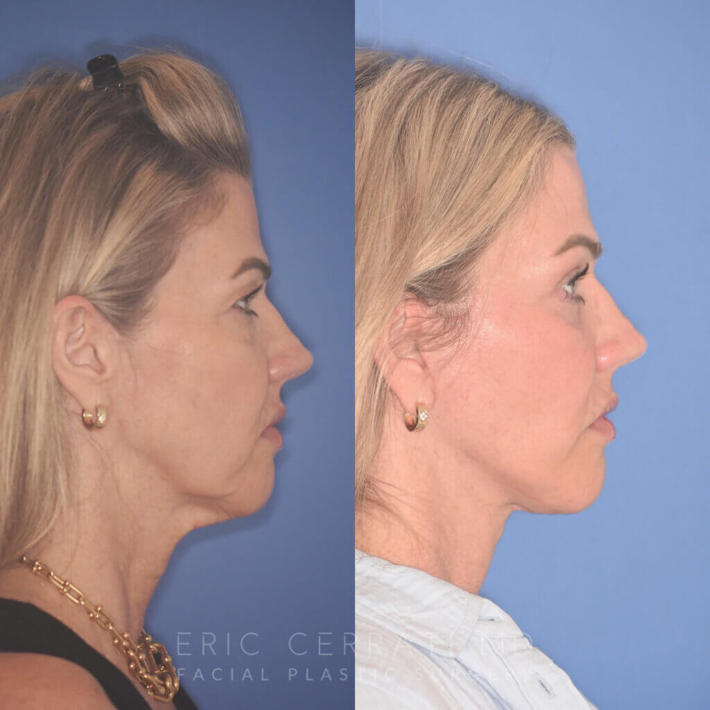 52 YR - 3.5 Months Postop: Endoscopic Browlift, Upper Blepharoplasty, Lower Blepharoplasty, Facelift, Buccal Fat Reduction, Laser Resurfacing