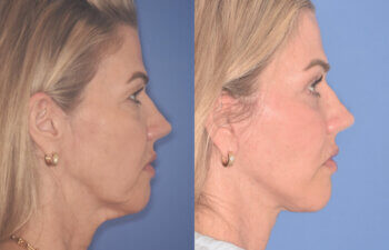 52 YR - 3.5 Months Postop: Endoscopic Browlift, Upper Blepharoplasty, Lower Blepharoplasty, Facelift, Buccal Fat Reduction, Laser Resurfacing