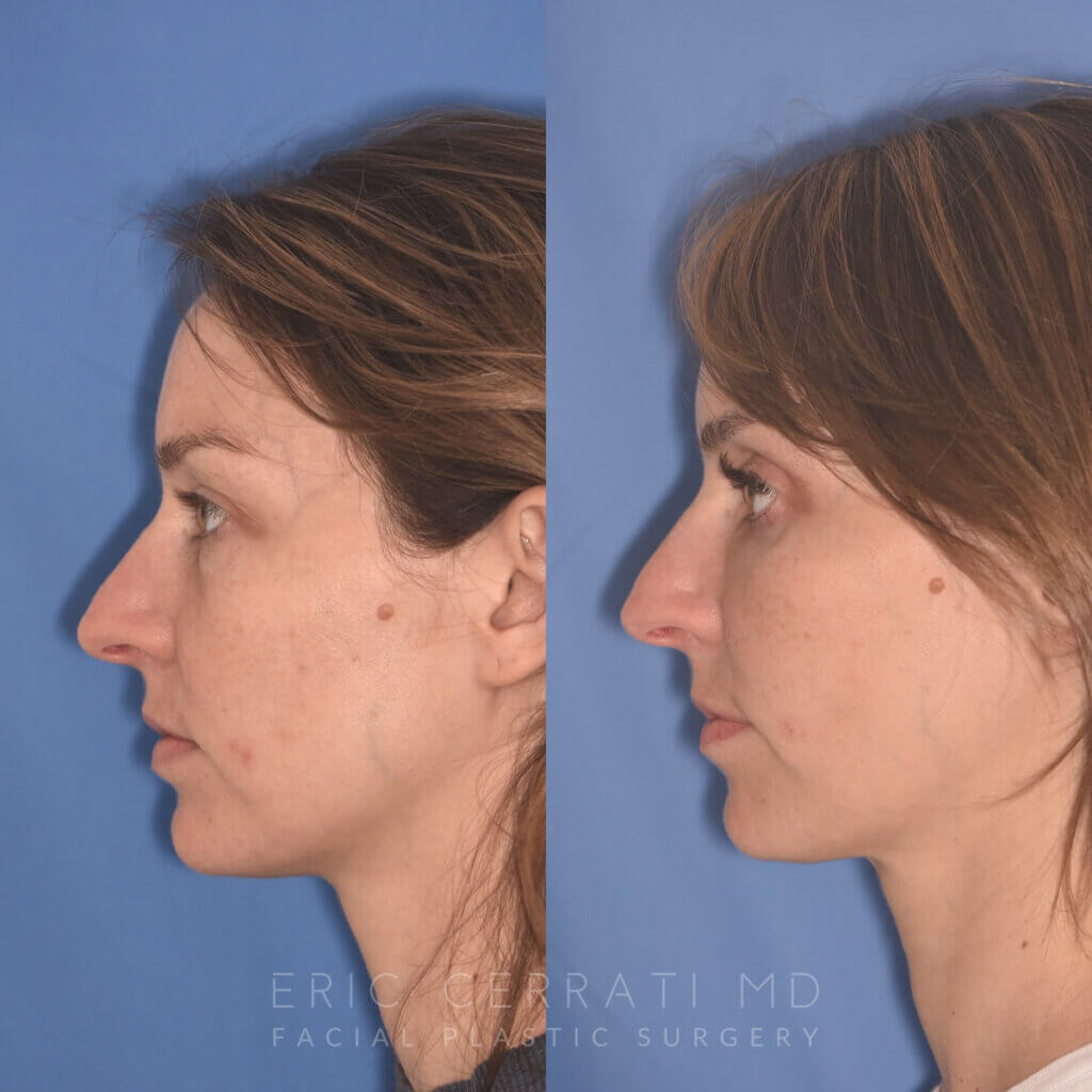 36 YR - 2 Months Postop: Upper Blepharoplasty, Lower Blepharoplasty, Fat Transfer