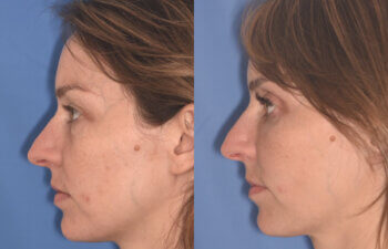 36 YR - 2 Months Postop: Upper Blepharoplasty, Lower Blepharoplasty, Fat Transfer